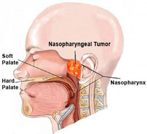 Nasopharynx Cancer