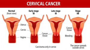 cervical cancer